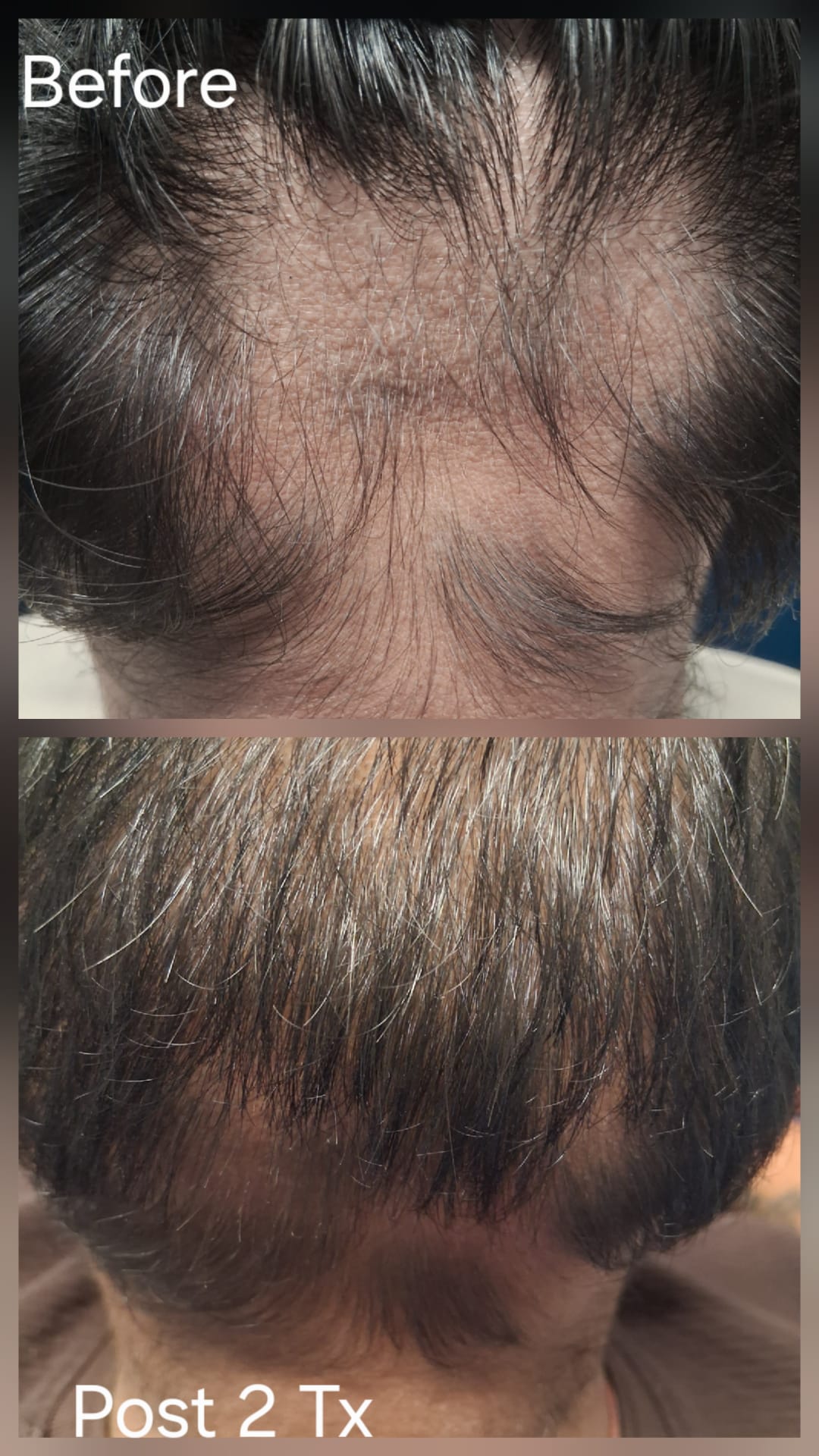 Hair restoration result